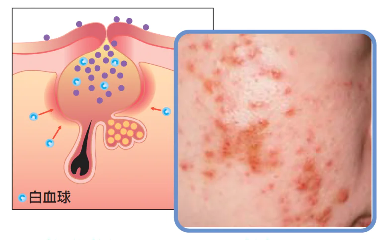 紅色丘疹（赤にきび）・膿疱（黄にきび）