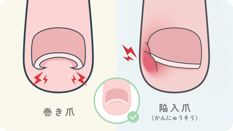 巻き爪と陥入爪