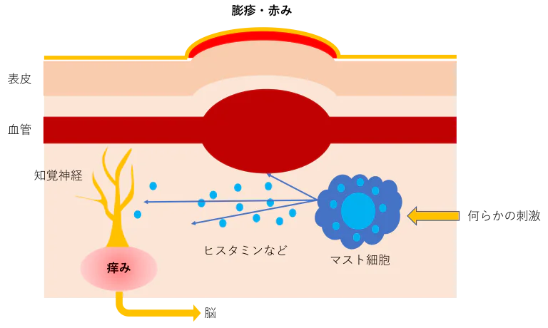 蕁麻疹のメカニズム