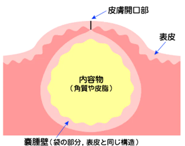 粉瘤（アテローム・表皮嚢腫）とは