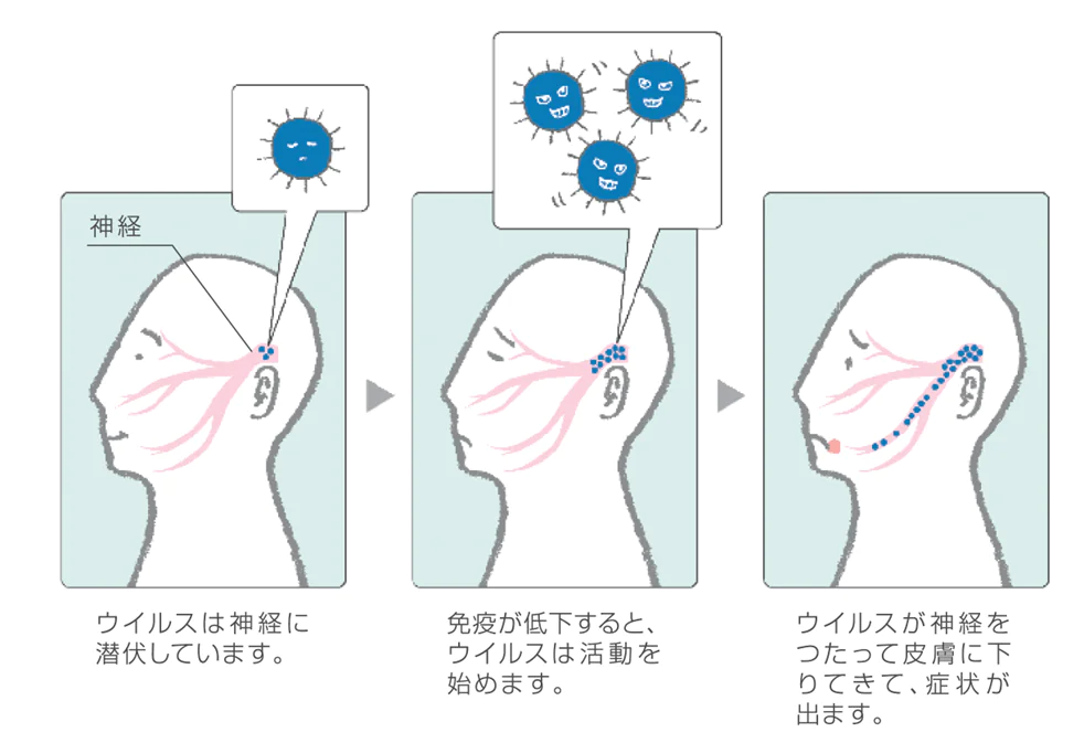 単純疱疹