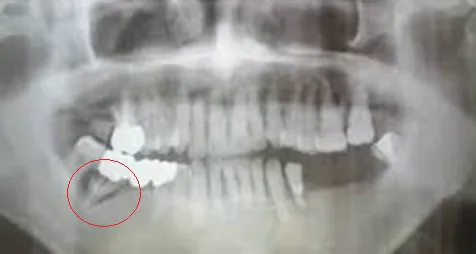 歯根部膿瘍