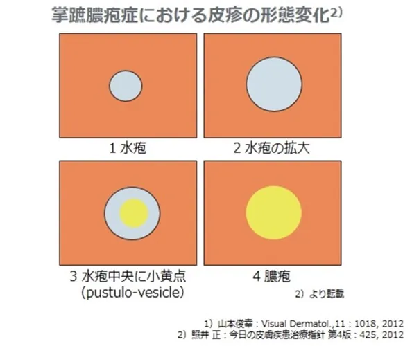 掌蹠膿疱症における皮疹の形態変化