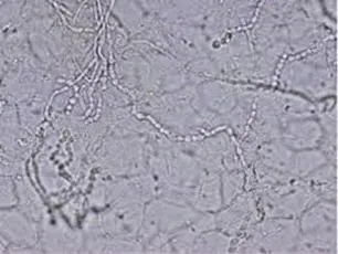 水虫の検査・診断