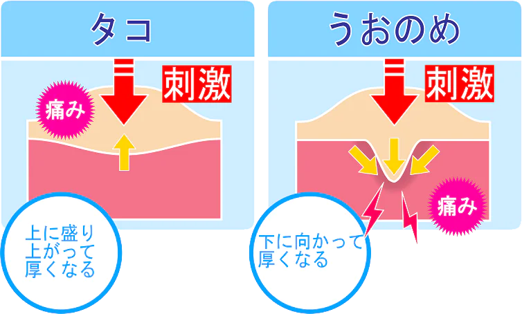 タコ（胼胝）・魚の目（鶏眼）とは