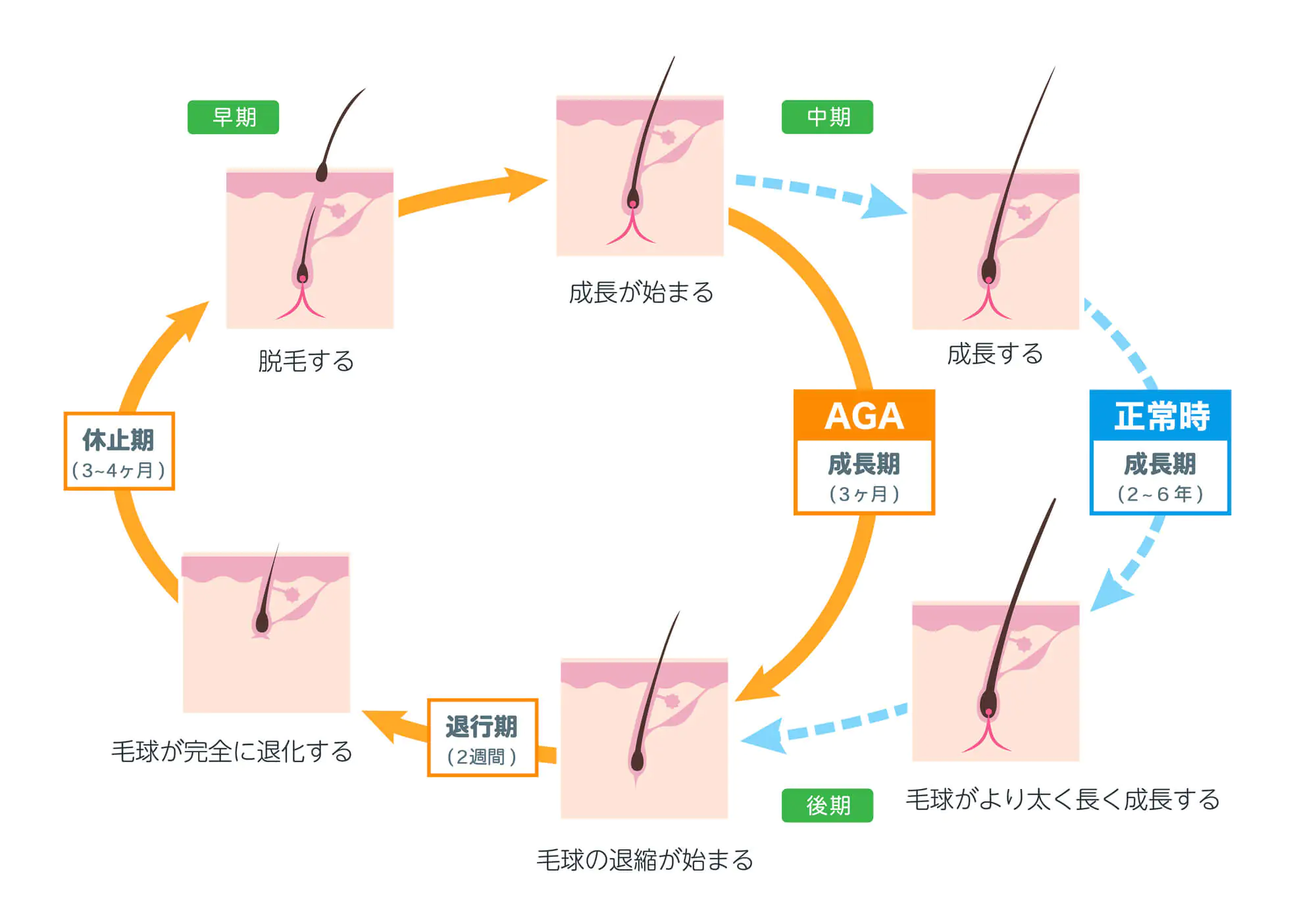 正常なヘアサイクルとAGAのメカニズム