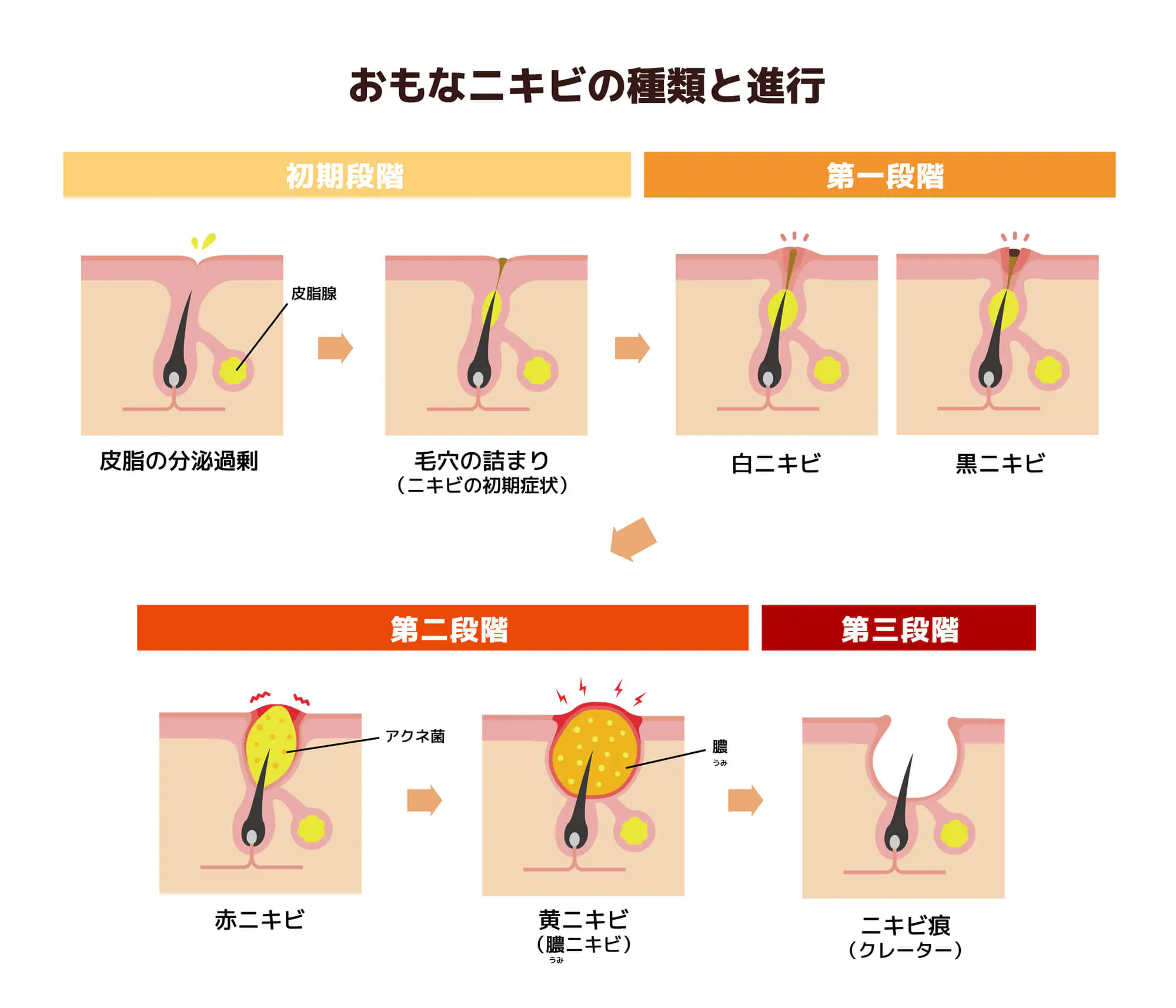 にきびの原因