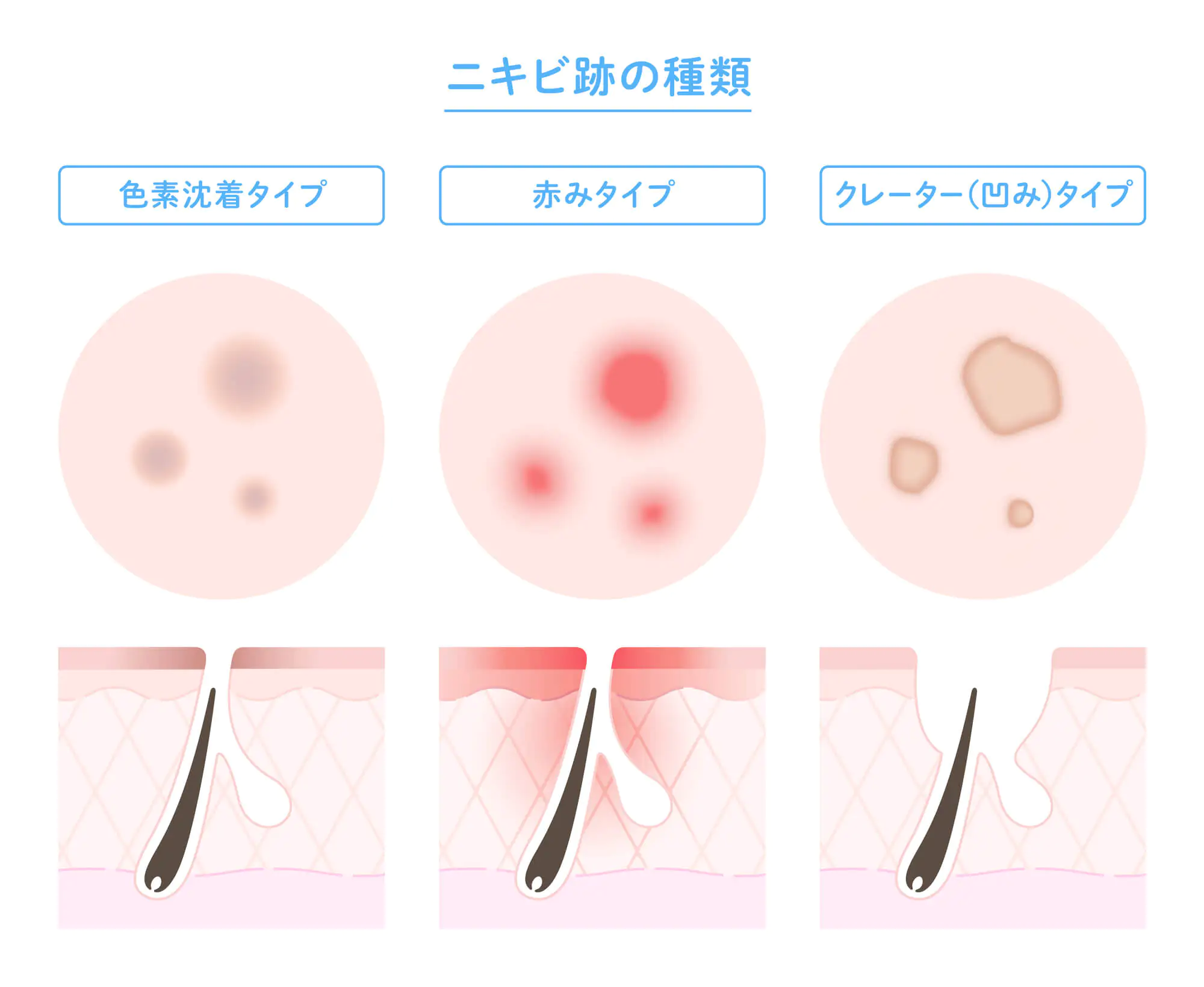 ケミカルピーリングで効果があるにきび痕の種類