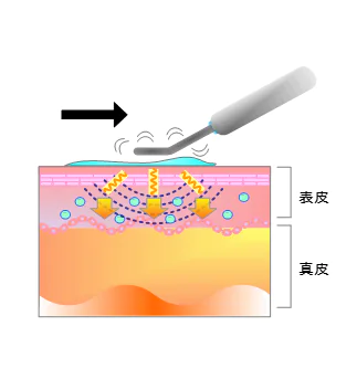 イオン導入・パッティング